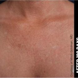 Ultherapy Before & After Patient #1556